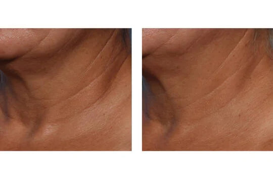 Skinbetter Science Techno Neck Perfecting Cream