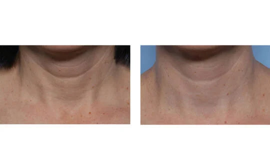 Skinbetter Science Techno Neck Perfecting Cream