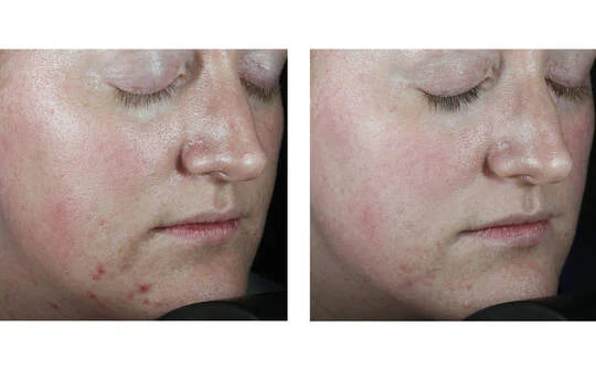 Skinbetter Science Clarity Regimen