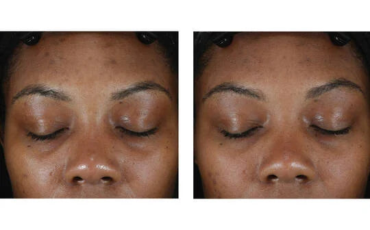 Skinbetter Science Clarity Regimen