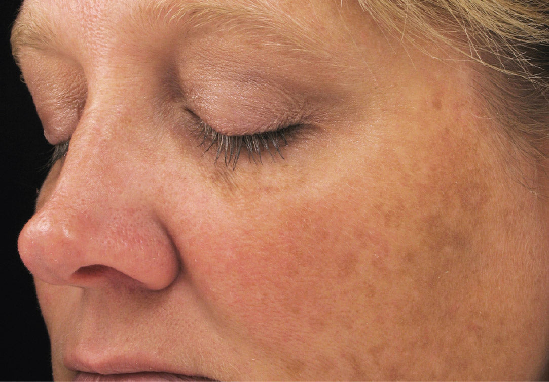 IS Clinical Brightening Complex