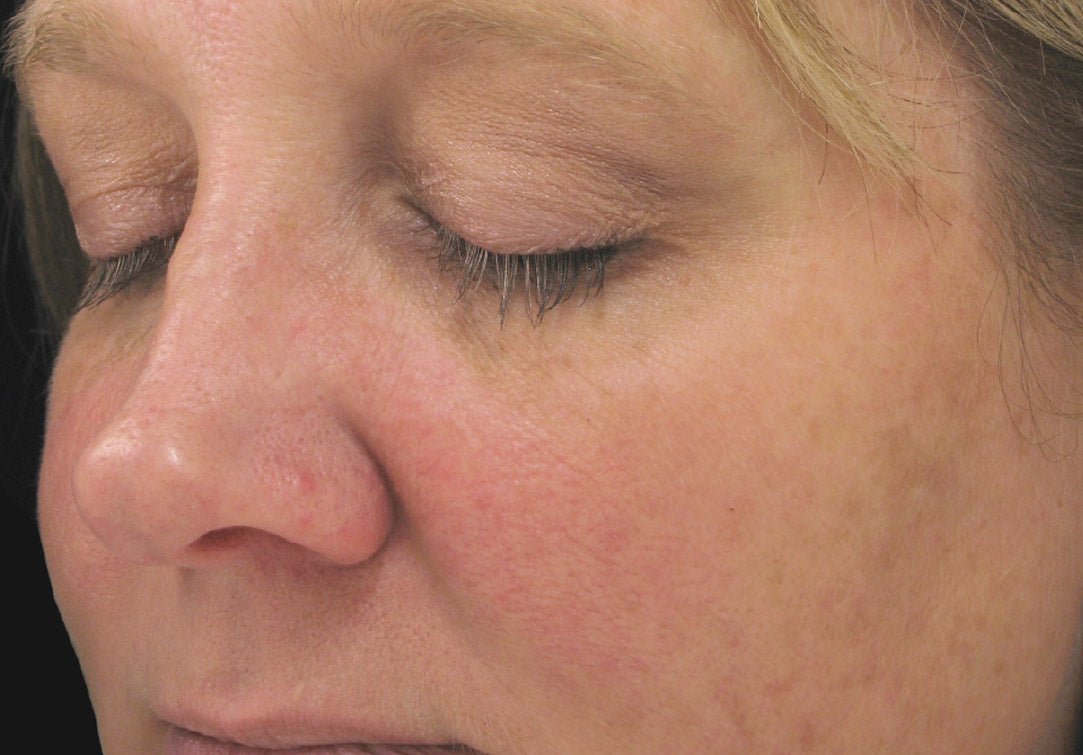 IS Clinical Brightening Complex
