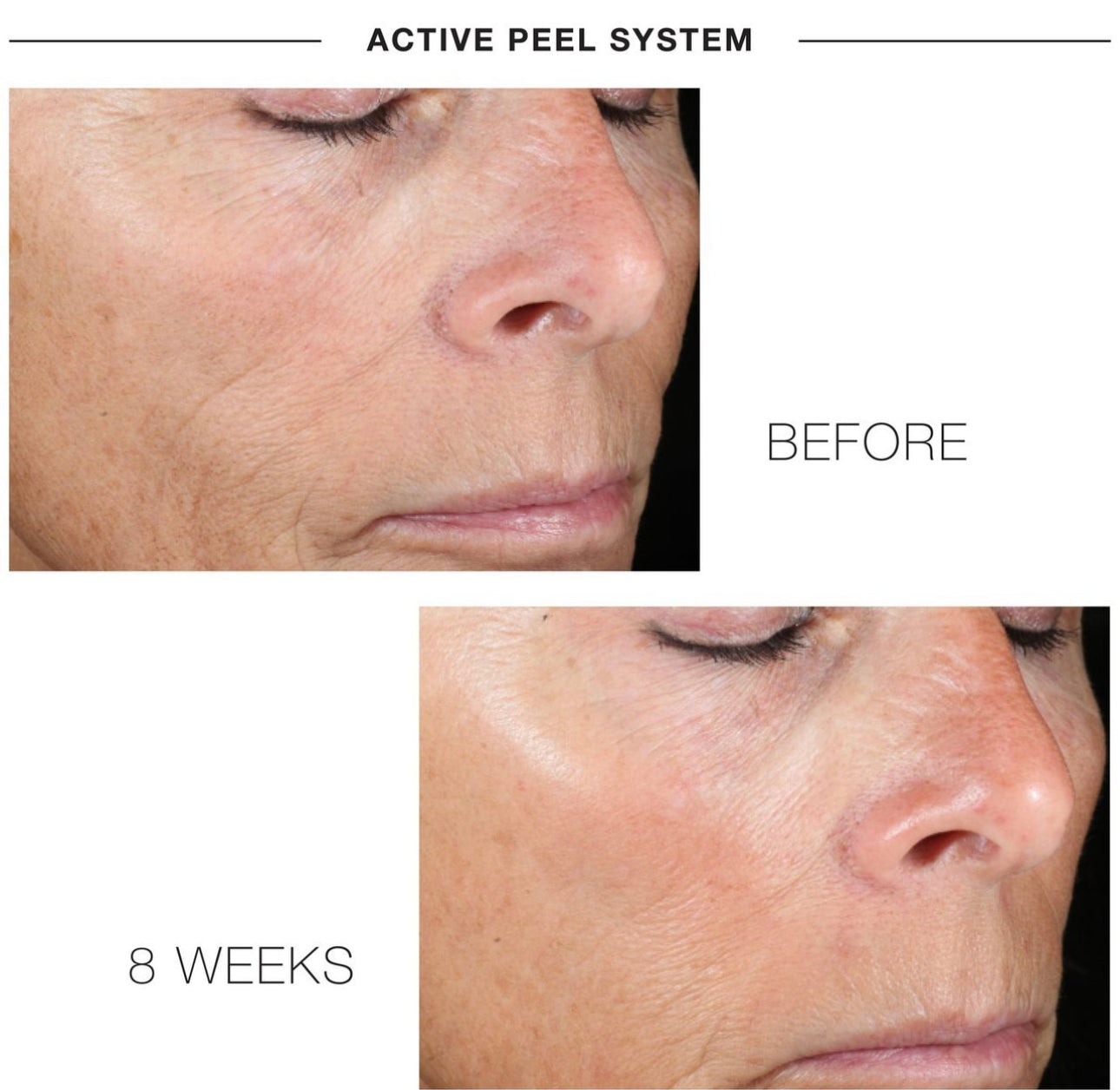 IS Clinical Active Peel System