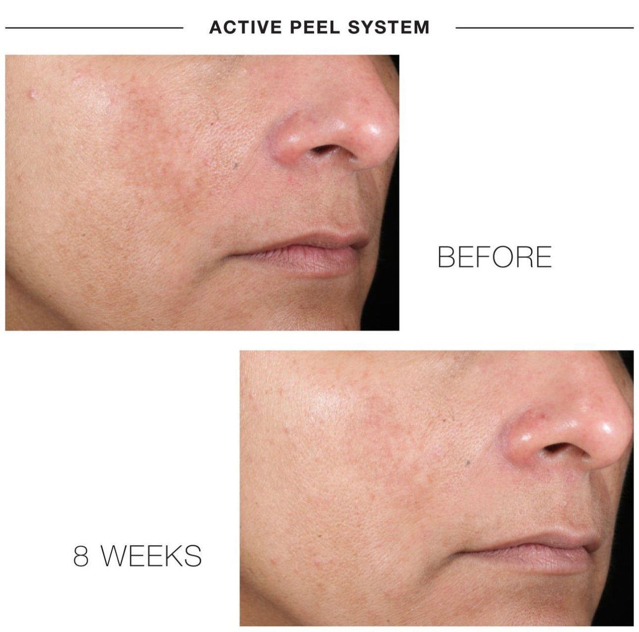 IS Clinical Active Peel System