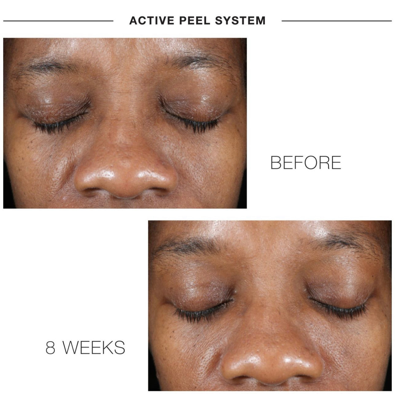 IS Clinical Active Peel System